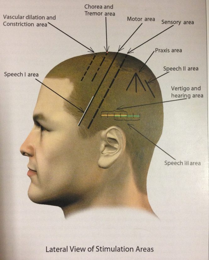 Featured image for The History of Acupuncture: A Long Journey to Health