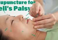 Featured image for Acupuncture for Bell's Palsy: Restore Facial Function