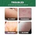 Content image for Allergies and Eczema: Soothing Irritated Skin