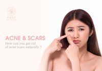 Featured image for How to Get Rid of Acne Scars