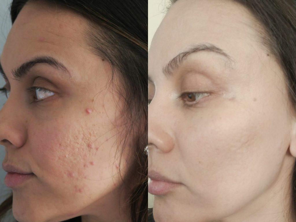 Content image for How to Get Rid of Acne Scars