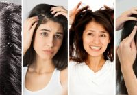 Featured image for How to Get Rid of Dandruff