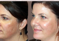 Featured image for Laser Skin Resurfacing: Improving Skin Texture and Tone