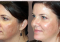 Featured image for Laser Skin Resurfacing: Improving Skin Texture and Tone