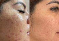 Featured image for Chemical Peels: Exfoliating for Smoother Skin