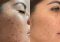 Featured image for Chemical Peels: Exfoliating for Smoother Skin
