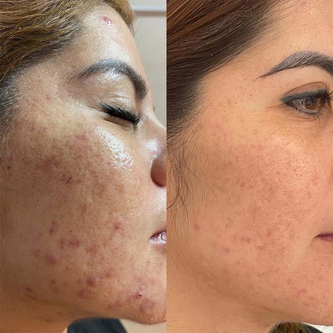 Featured image for Chemical Peels: Exfoliating for Smoother Skin