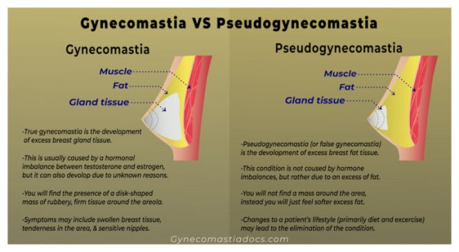 Featured image for Male Breast Reduction (Gynecomastia Surgery): Reducing Chest Fat
